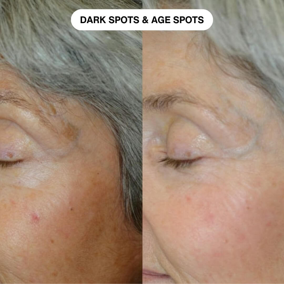 Ryte Micro Infusion System