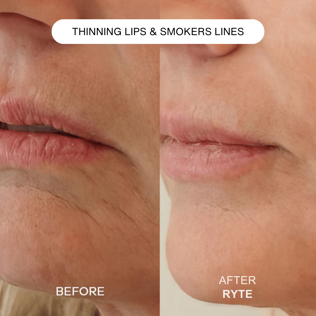 Ryte Micro Infusion System