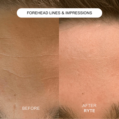 Ryte Micro Infusion System