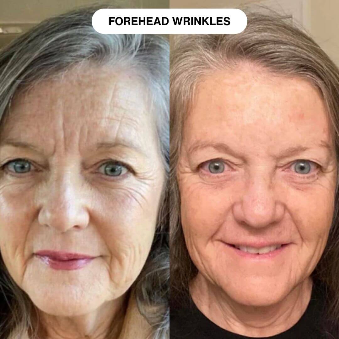 Ryte Micro Infusion System