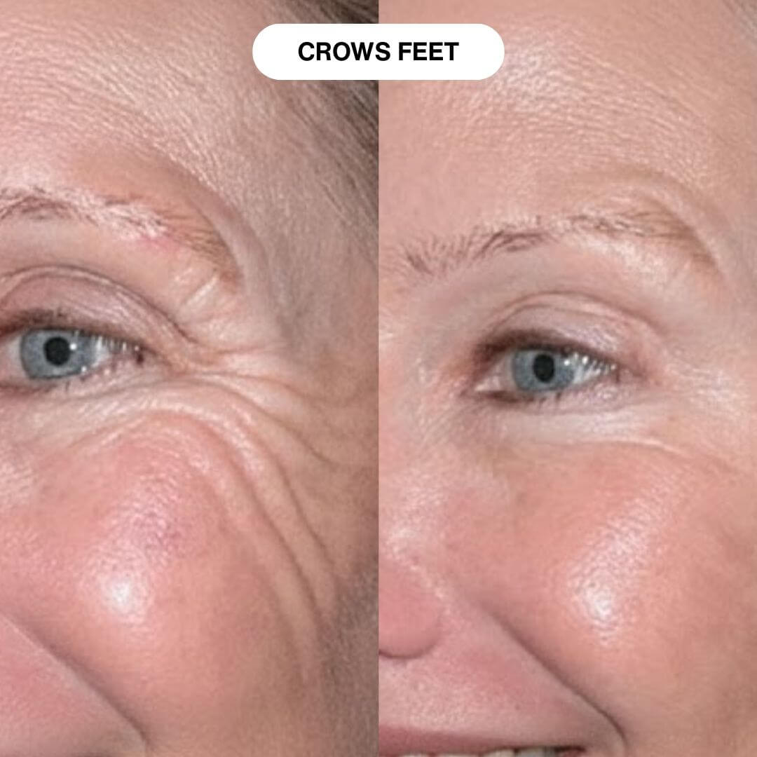 Ryte Micro-Infusion System