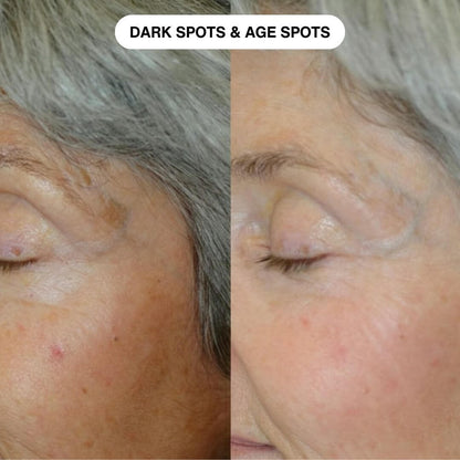 Ryte Micro Infusion System