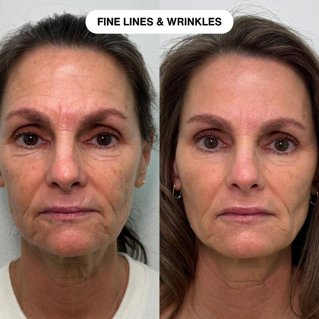 Ryte Micro Infusion System