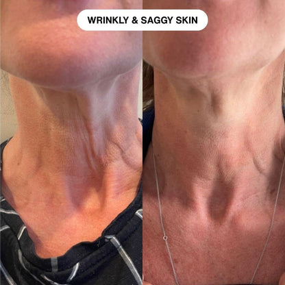 Ryte Micro Infusion System